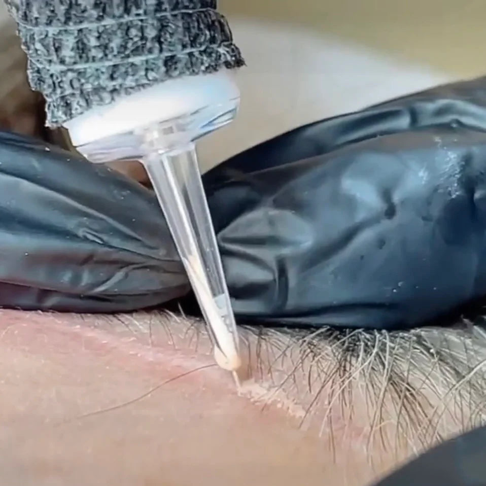 PMU Tatto Removal